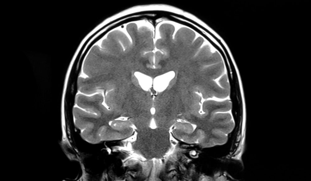 Brain MRI