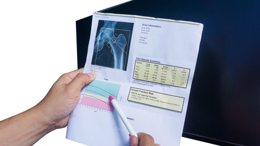 Bone density scan (DEXA scan) - How it is performed - NHS