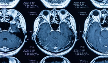 Brain MRI Images