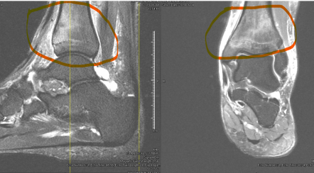 Ankle fracture MRI