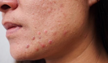 Maskne: Prevention and Treatment