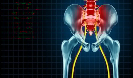Sciatica Nerve Pain