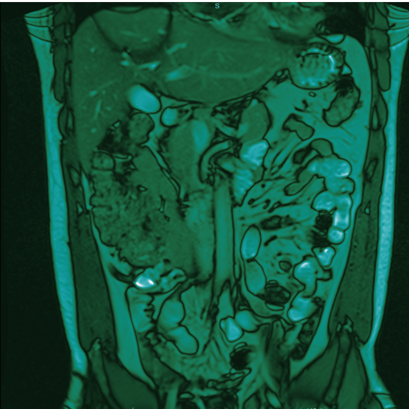 Lungs MRI