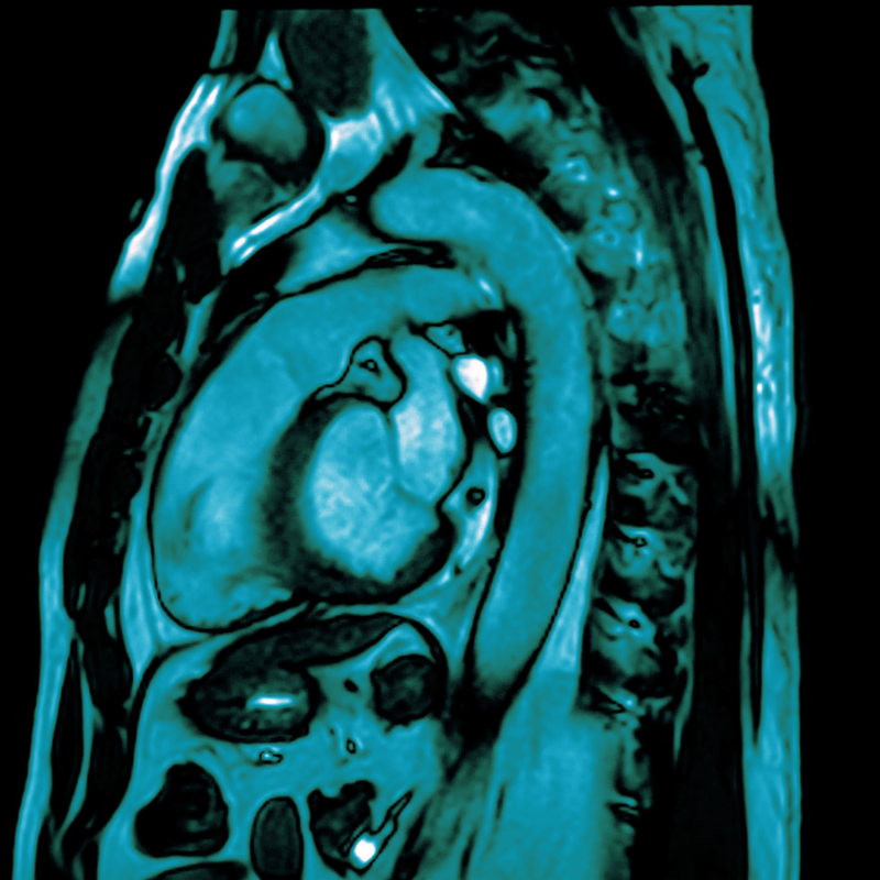 Heart MRI